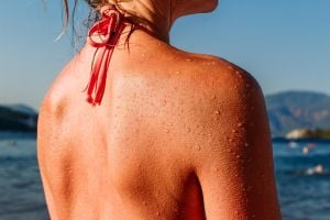 Verbrand door de zon: 8 tips voor je huid